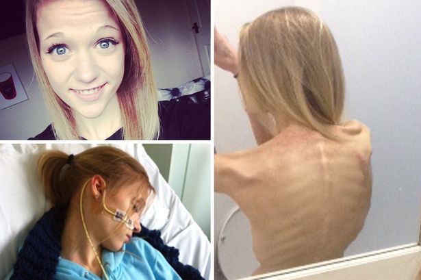 Anorexic Selfies Provoke Teenage Eating Disorders Theselfiepost